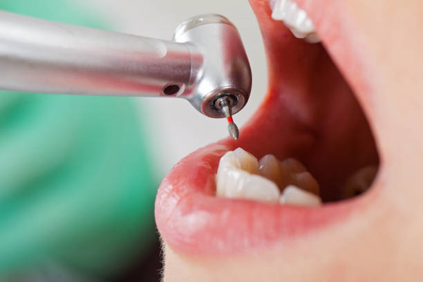Best Emergency Dental Filling Replacement  in Fort Benton, MT